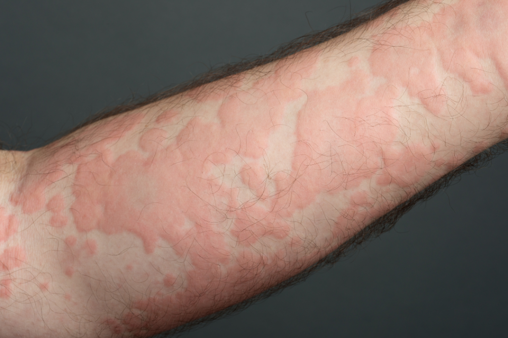 alergijska reakcija, vnetje kože